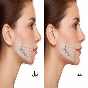چه کسانی بعد از جراحی فک باید جراحی چانه انجام دهند؟